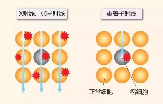 質(zhì)子重離子技術(shù)醫療險可以報銷(xiāo)嗎？
