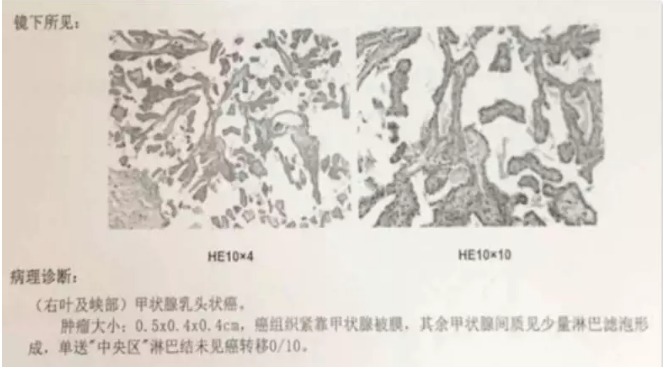 別慌，甲狀腺疾病還可以這樣投保！